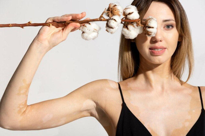Vitiligo therapy