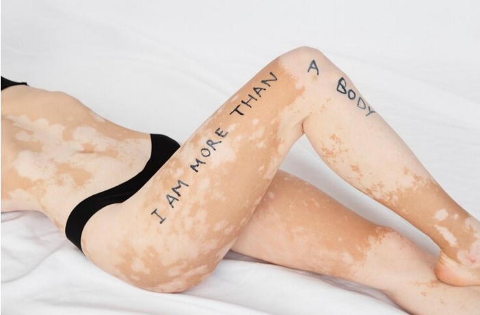 Vitiligo