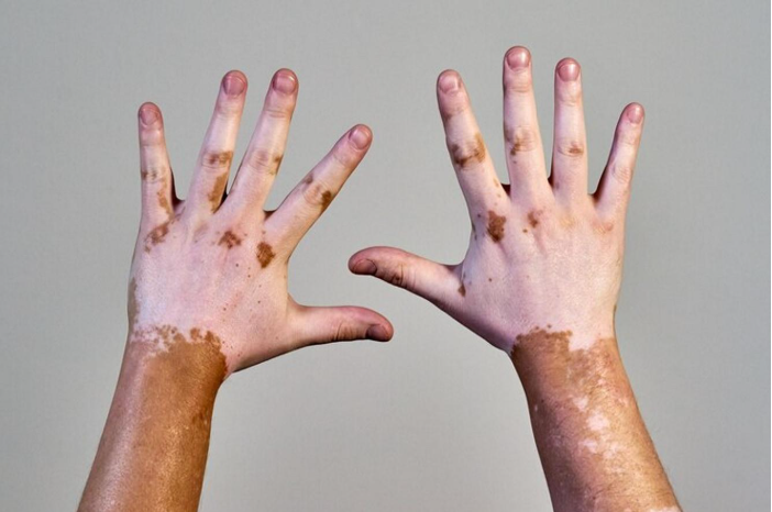 Vitiligo hand