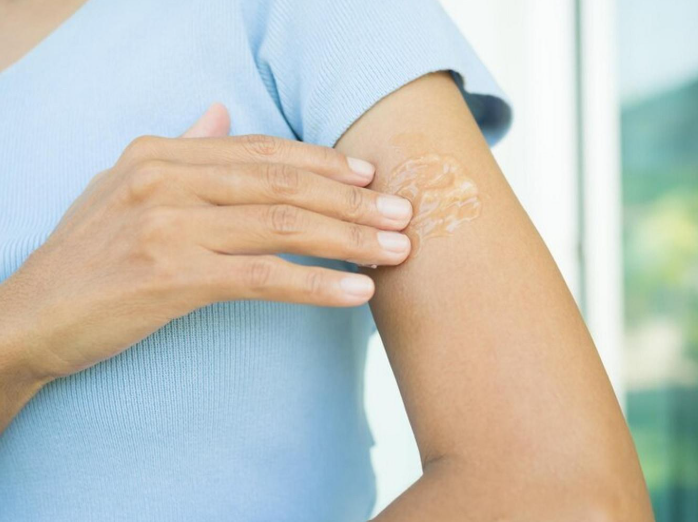 Vitiligo cream