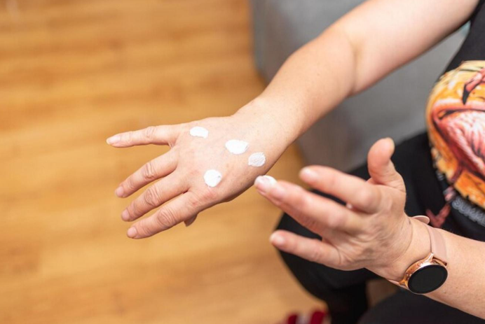vitiligo cream