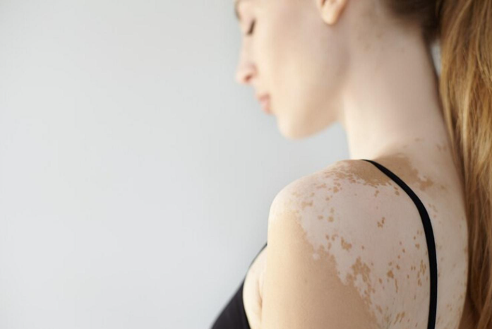 vitiligo skin