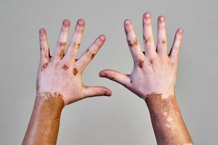 Vitiligo hand
